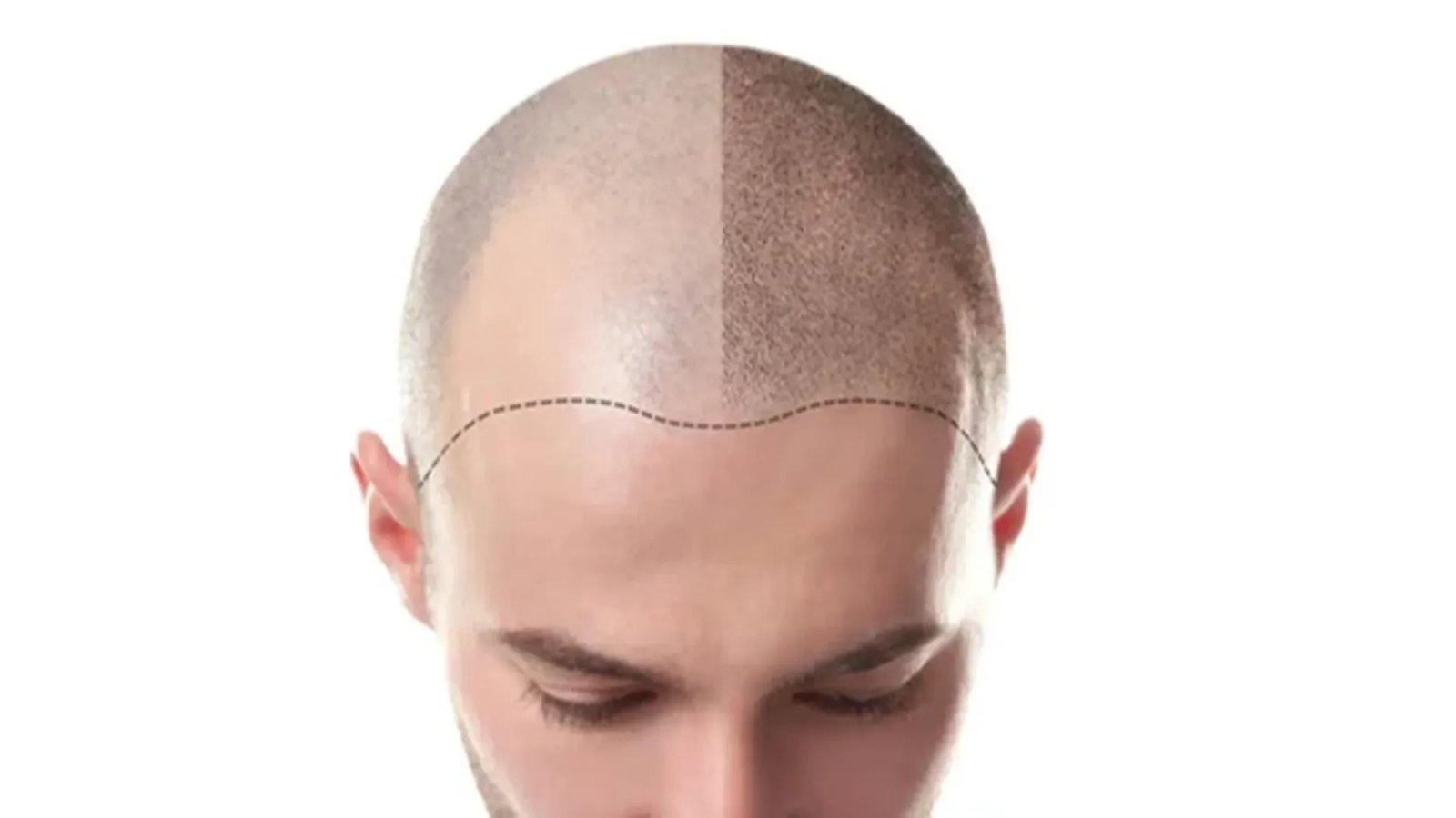 Hair Transplantation